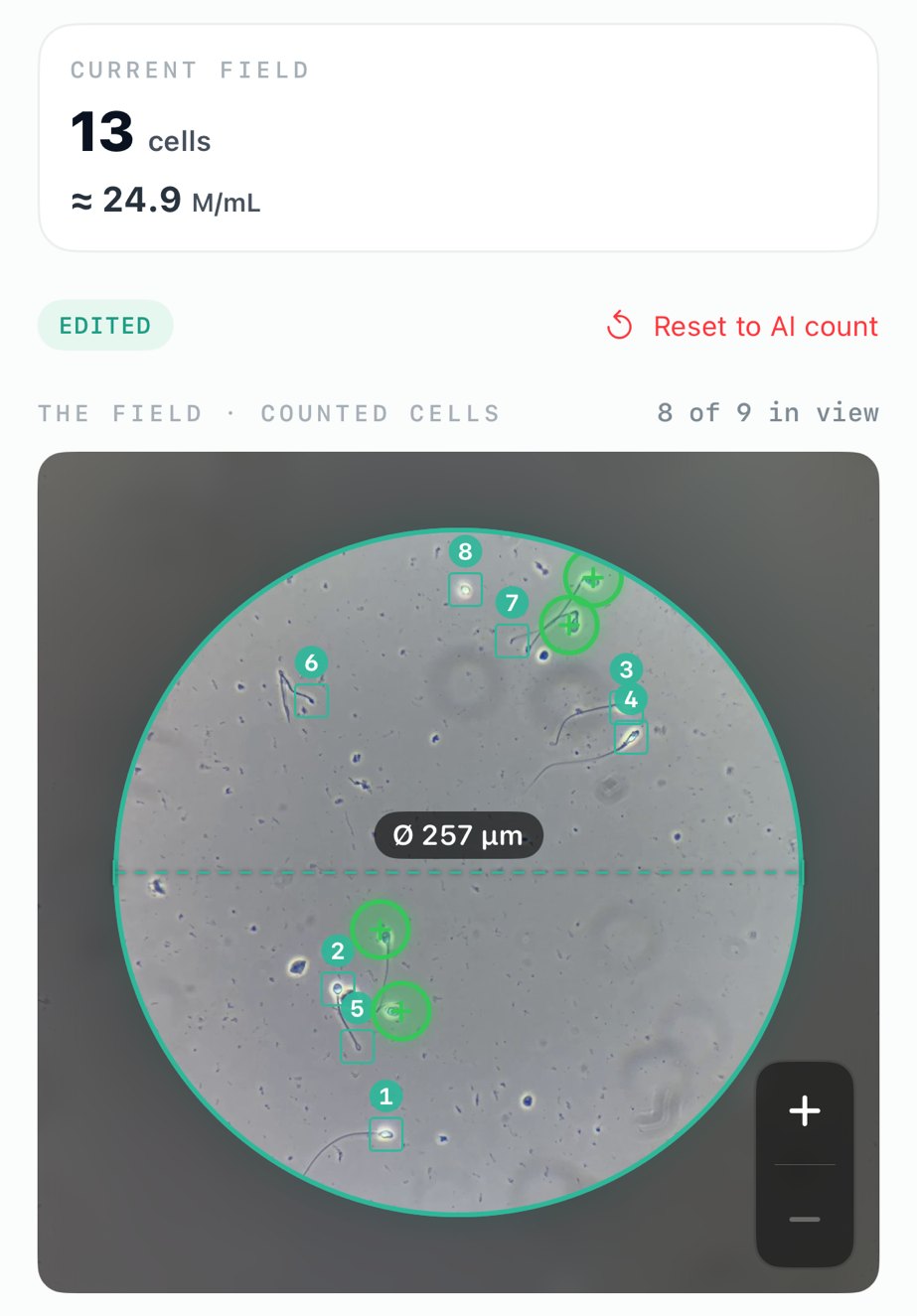 The analysis screen: a microscope field with each counted sperm cell boxed and numbered, above a concentration result of 24.9 million per millilitre